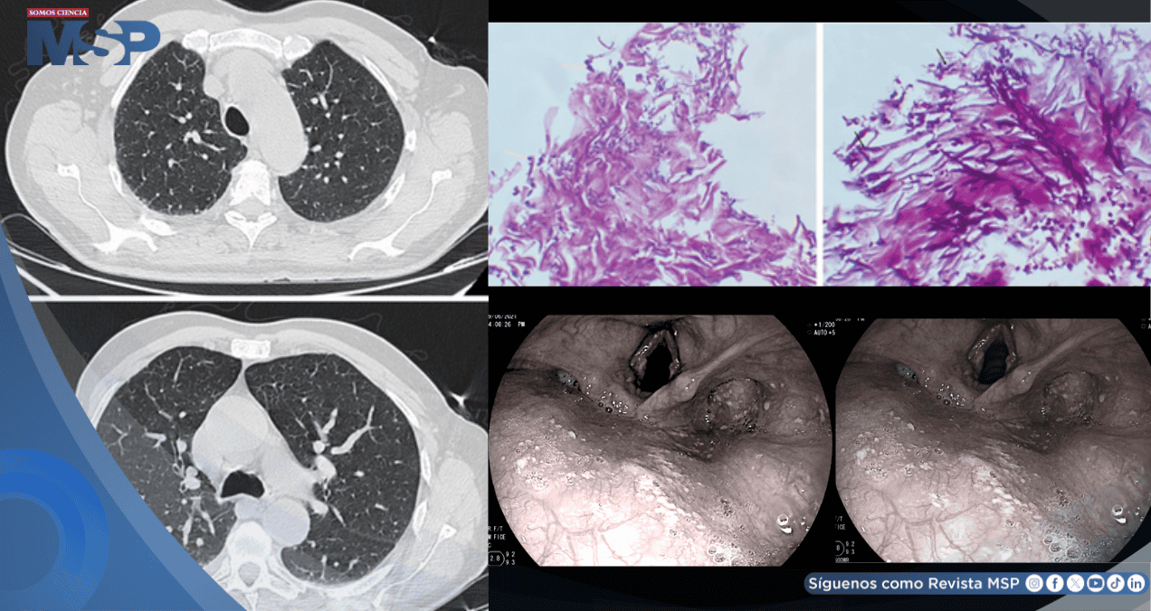 Candidiasis esofágica en hombre con asma tras automedicarse con fluticasona y tragar enjuague bucal Candidiasis esofágica en hombre con asma tras automedicarse con fluticasona y tragar enjuague bucal