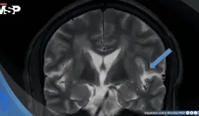 Síndrome de encefalopatía posterior reversible asociado a crisis hipertensiva con estado epiléptico