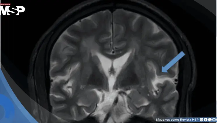 Síndrome de encefalopatía posterior reversible asociado a crisis hipertensiva con estado epiléptico