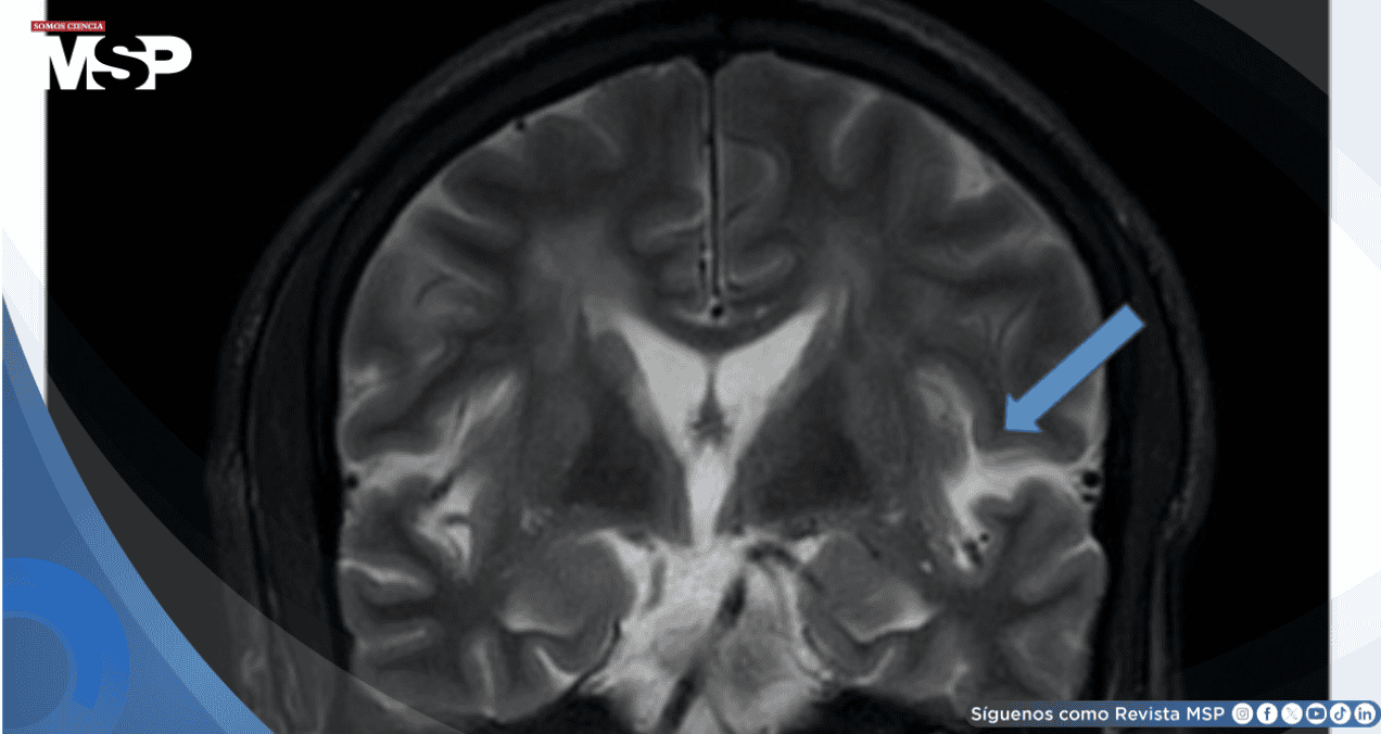 Síndrome de encefalopatía posterior reversible asociado a crisis hipertensiva con estado epiléptico