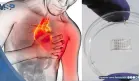 Desarrollan parche inteligente que podría regenerar el corazón tras un infarto