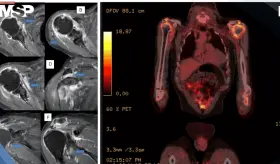 Dolor persistente en hombros y rigidez matutina revelan un caso severo de polimialgia reumática