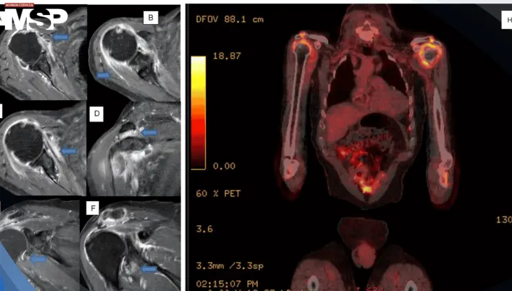 Dolor persistente en hombros y rigidez matutina revelan un caso severo de polimialgia reumática 
