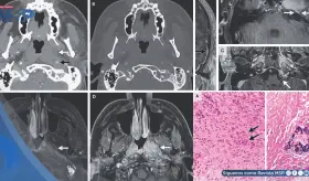 Paciente con dolor de oído y parálisis facial es diagnosticado con vasculitis sistémica