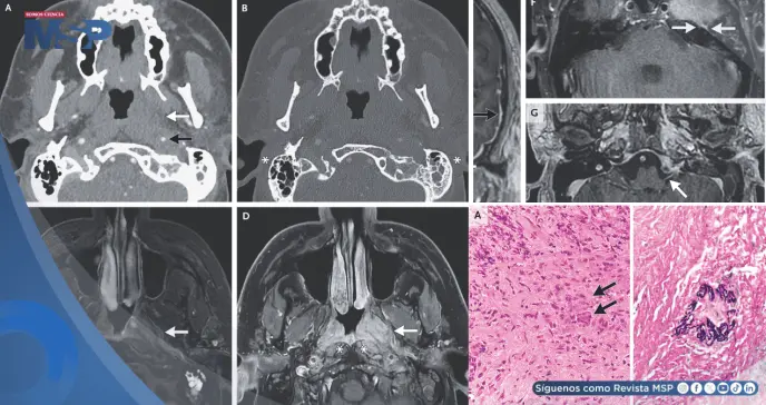 Paciente con dolor de oído y parálisis facial es diagnosticado con vasculitis sistémica Paciente con dolor de oído y parálisis facial es diagnosticado con vasculitis sistémica