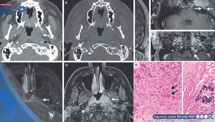 Paciente con dolor de oído y parálisis facial es diagnosticado con vasculitis sistémica Paciente con dolor de oído y parálisis facial es diagnosticado con vasculitis sistémica