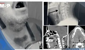Hematomas lingual y sublingual por warfarina causan obstrucción crítica de la vía aérea
