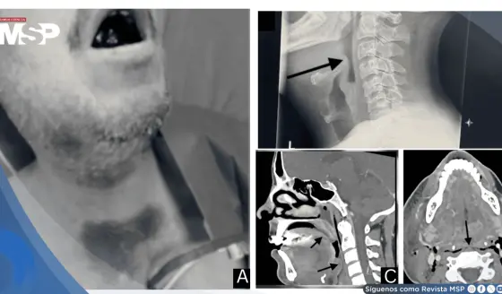 Hematomas lingual y sublingual por warfarina causan obstrucción crítica de la vía aérea 
