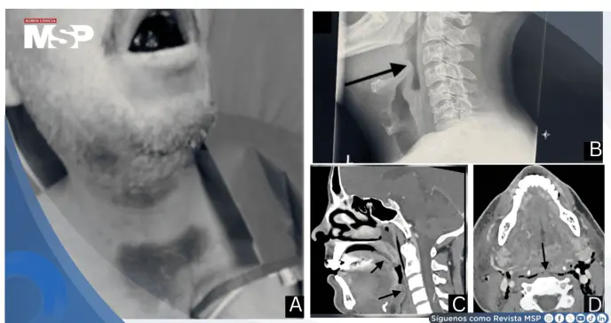 Hematomas lingual y sublingual por warfarina causan obstrucción crítica de la vía aérea 