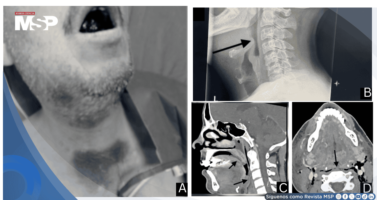 Hematomas lingual y sublingual por warfarina causan obstrucción crítica de la vía aérea Hematomas lingual y sublingual por warfarina causan obstrucción crítica de la vía aérea