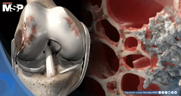 Osteonecrosis: Cómo el consumo excesivo de bebidas alcohólicas puede provocar muerte del tejido óseo