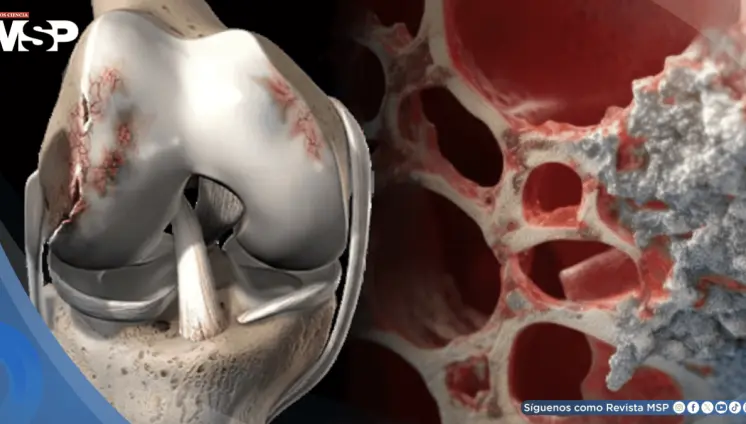 Osteonecrosis: Cómo el consumo excesivo de bebidas alcohólicas puede provocar muerte del tejido óseo