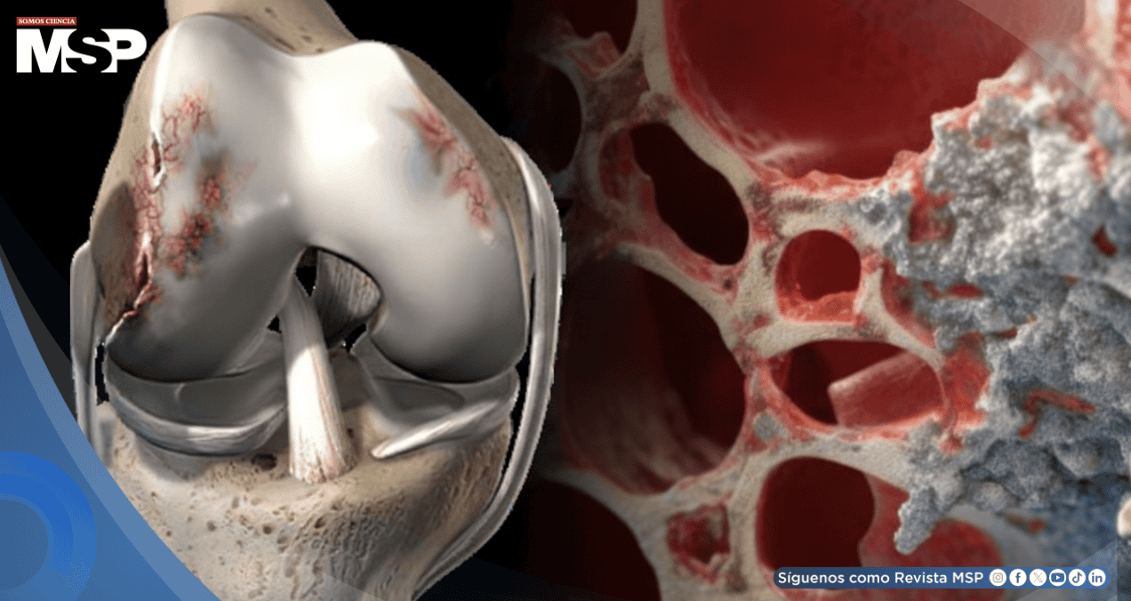 Osteonecrosis: Cómo el consumo excesivo de bebidas alcohólicas puede provocar muerte del tejido óseo Osteonecrosis: Cómo el consumo excesivo de bebidas alcohólicas puede provocar muerte del tejido óseo
