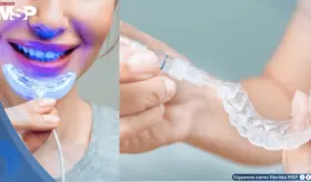 Alertan sobre kits de blanqueamiento no regulados con exceso de peróxido: dañarían el esmalte y encías