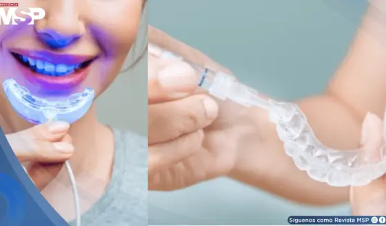 Alertan sobre kits de blanqueamiento no regulados con exceso de peróxido: dañarían el esmalte y encías