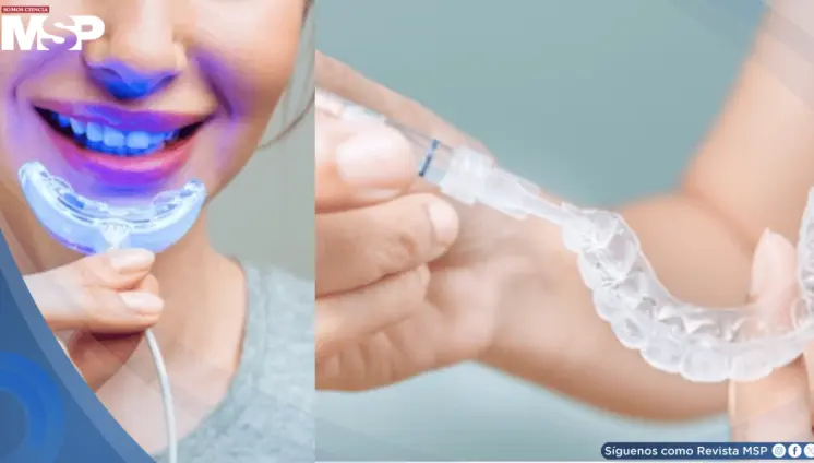 Alertan sobre kits de blanqueamiento no regulados con exceso de peróxido: dañarían el esmalte y encías