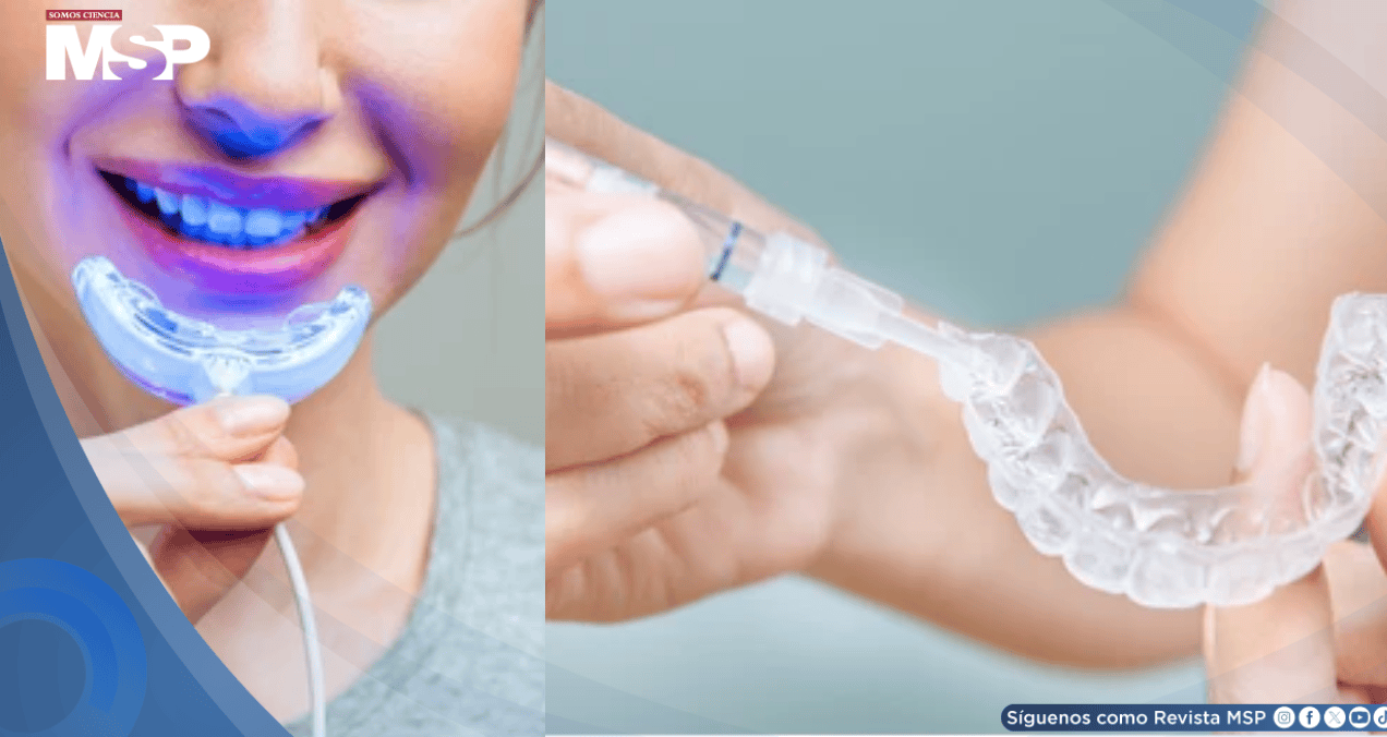 Alertan sobre kits de blanqueamiento no regulados con exceso de peróxido: dañarían el esmalte y encías Alertan sobre kits de blanqueamiento no regulados con exceso de peróxido: dañarían el esmalte y encías