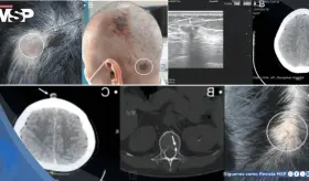 Detectan metástasis en cuero cabelludo como primera señal en dos mujeres con cáncer de mama avanzado