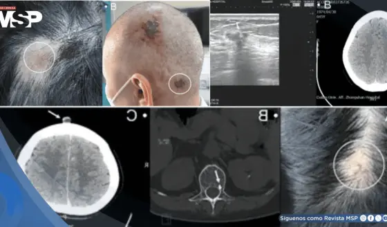 Detectan metástasis en cuero cabelludo como primera señal en dos mujeres con cáncer de mama avanzado