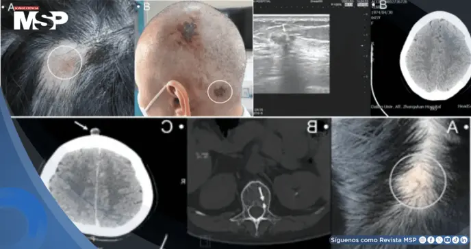 Detectan metástasis en cuero cabelludo como primera señal en dos mujeres con cáncer de mama avanzado