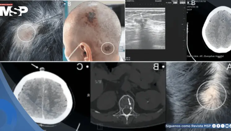 Detectan metástasis en cuero cabelludo como primera señal en dos mujeres con cáncer de mama avanzado Detectan metástasis en cuero cabelludo como primera señal en dos mujeres con cáncer de mama avanzado