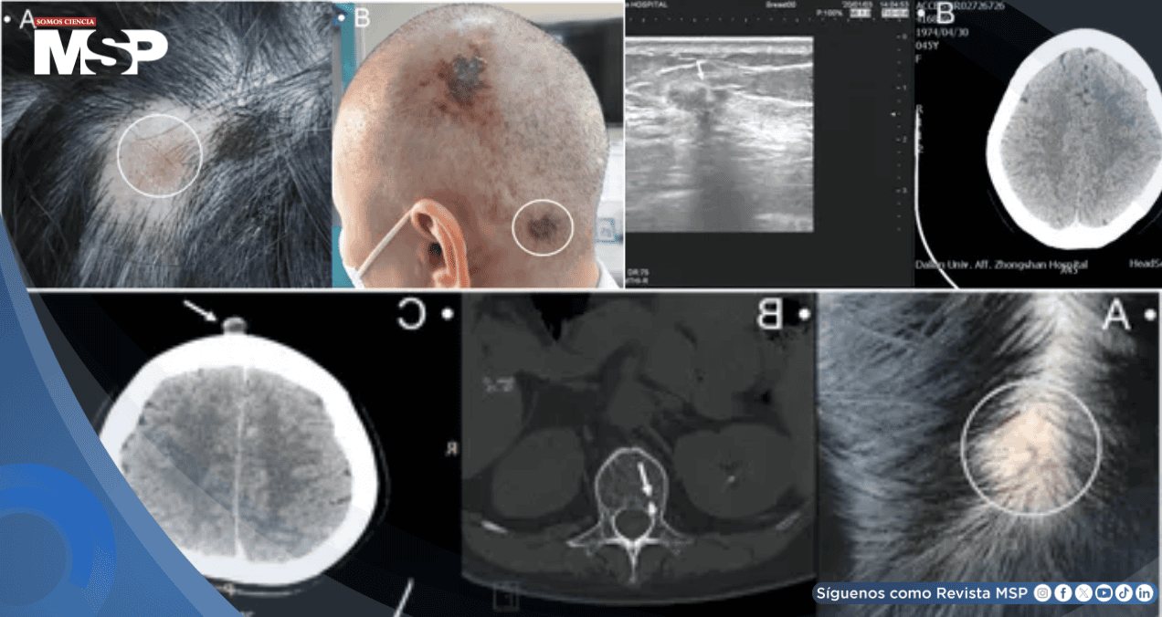 Detectan metástasis en cuero cabelludo como primera señal en dos mujeres con cáncer de mama avanzado