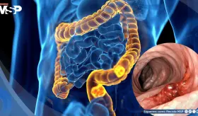 Revelan cómo el cáncer colorrectal evade la inmunoterapia y abren nuevas vías de tratamiento