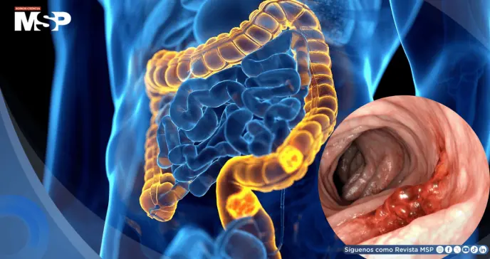 Revelan cómo el cáncer colorrectal evade la inmunoterapia y abren nuevas vías de tratamiento