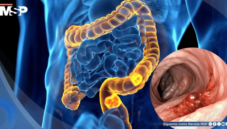 Revelan cómo el cáncer colorrectal evade la inmunoterapia y abren nuevas vías de tratamiento