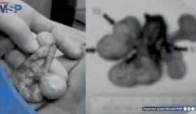 Detectan tres testículos independientes en hombre de 30 años tras dolor crónico persistente