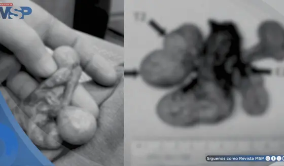 Detectan tres testículos independientes en hombre de 30 años tras dolor crónico persistente