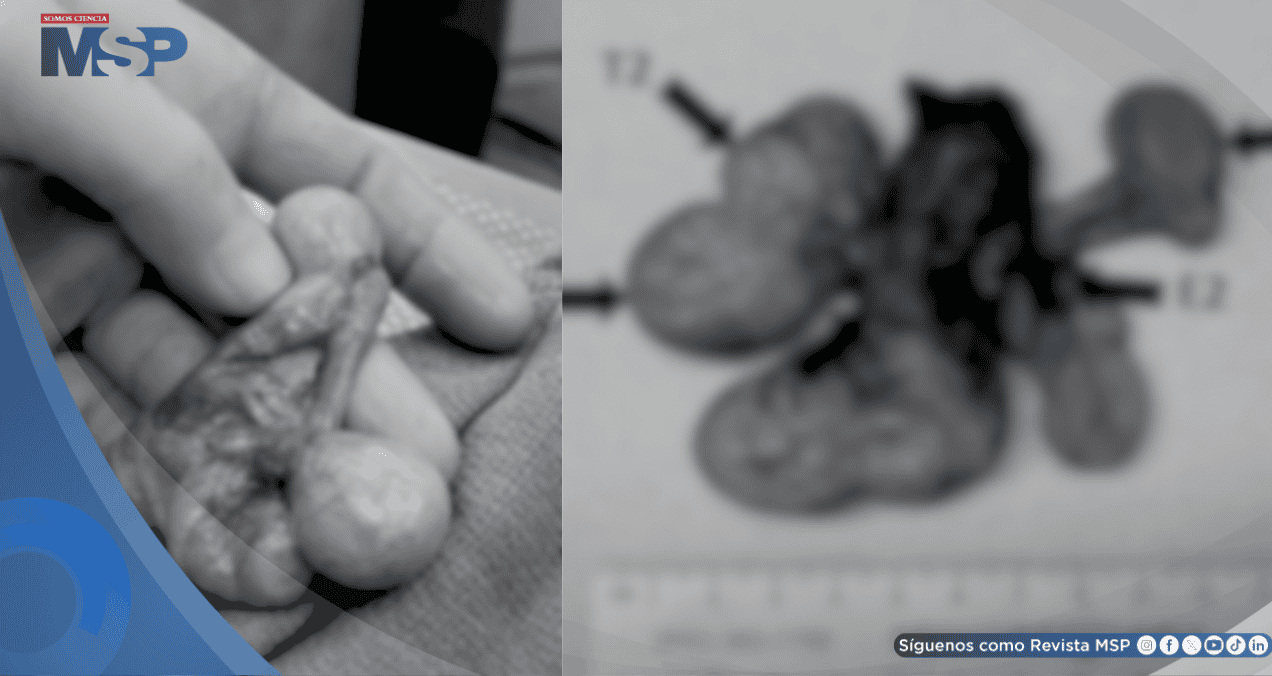 Detectan tres testículos independientes en hombre de 30 años tras dolor crónico persistente
