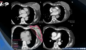 Cáncer de mama triple negativo metastásico con masa ulcerada y purulenta muestra respuesta a FAST-Forward