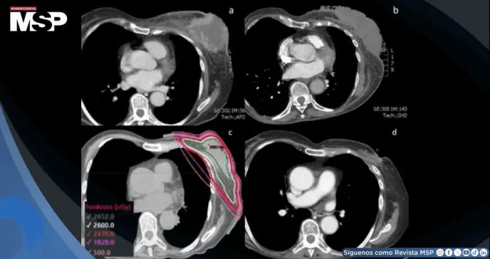 Cáncer de mama triple negativo metastásico con masa ulcerada y purulenta muestra respuesta a FAST-Forward Cáncer de mama triple negativo metastásico con masa ulcerada y purulenta muestra respuesta a FAST-Forward