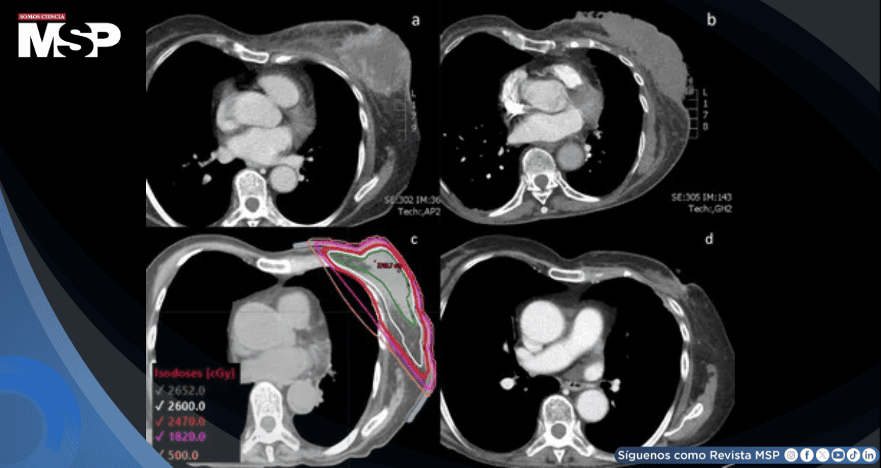 Cáncer de mama triple negativo metastásico con masa ulcerada y purulenta muestra respuesta a FAST-Forward Cáncer de mama triple negativo metastásico con masa ulcerada y purulenta muestra respuesta a FAST-Forward