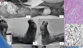 Sarcoma de Kaposi pasó desapercibido 2 años en paciente sin VIH: creían que era dermatitis