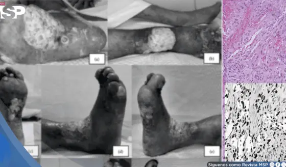 Sarcoma de Kaposi pasó desapercibido 2 años en paciente sin VIH: creían que era dermatitis