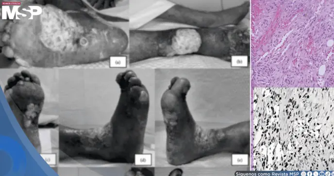 Sarcoma de Kaposi pasó desapercibido 2 años en paciente sin VIH: creían que era dermatitis