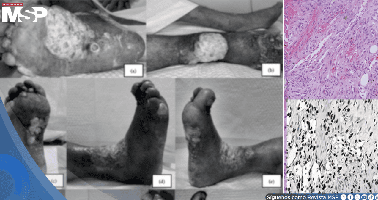 Sarcoma de Kaposi pasó desapercibido 2 años en paciente sin VIH: creían que era dermatitis