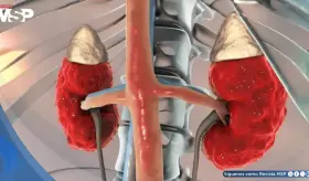 Enfermedad renal crónica afectaría a 800 millones de personas y es vinculada con mayor riesgo cardíaco