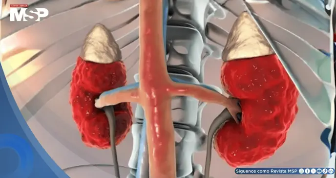 Enfermedad renal crónica afectaría a 800 millones de personas  y es vinculada con mayor riesgo cardíaco