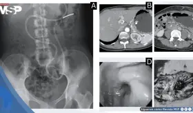 Adenomioma gástrico simula cáncer: Raro tumor benigno causó obstrucción pilórica y severa pérdida de peso