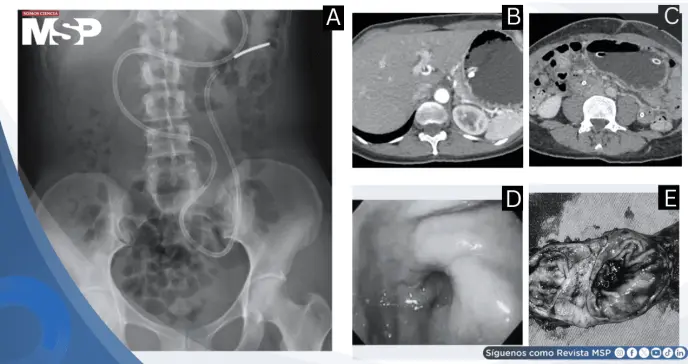 Adenomioma gástrico simula cáncer: Raro tumor benigno causó obstrucción pilórica y severa pérdida de peso