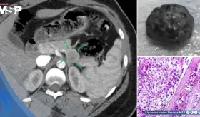Tras 3 años tratada por epilepsia y esquizofrenia descubren tumor pancreático que ocasionaba los síntomas