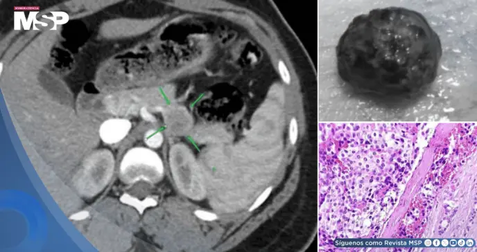 Tras 3 años tratada por epilepsia y esquizofrenia descubren tumor pancreático que ocasionaba los síntomas