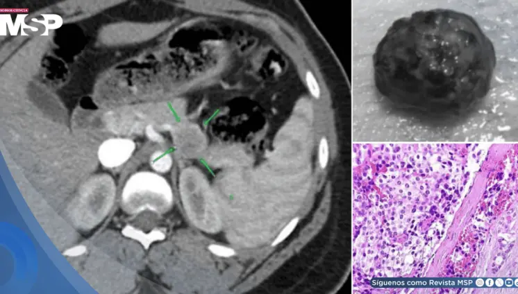 Tras 3 años tratada por epilepsia y esquizofrenia descubren tumor pancreático que ocasionaba los síntomas Tras 3 años tratada por epilepsia y esquizofrenia descubren tumor pancreático que ocasionaba los síntomas