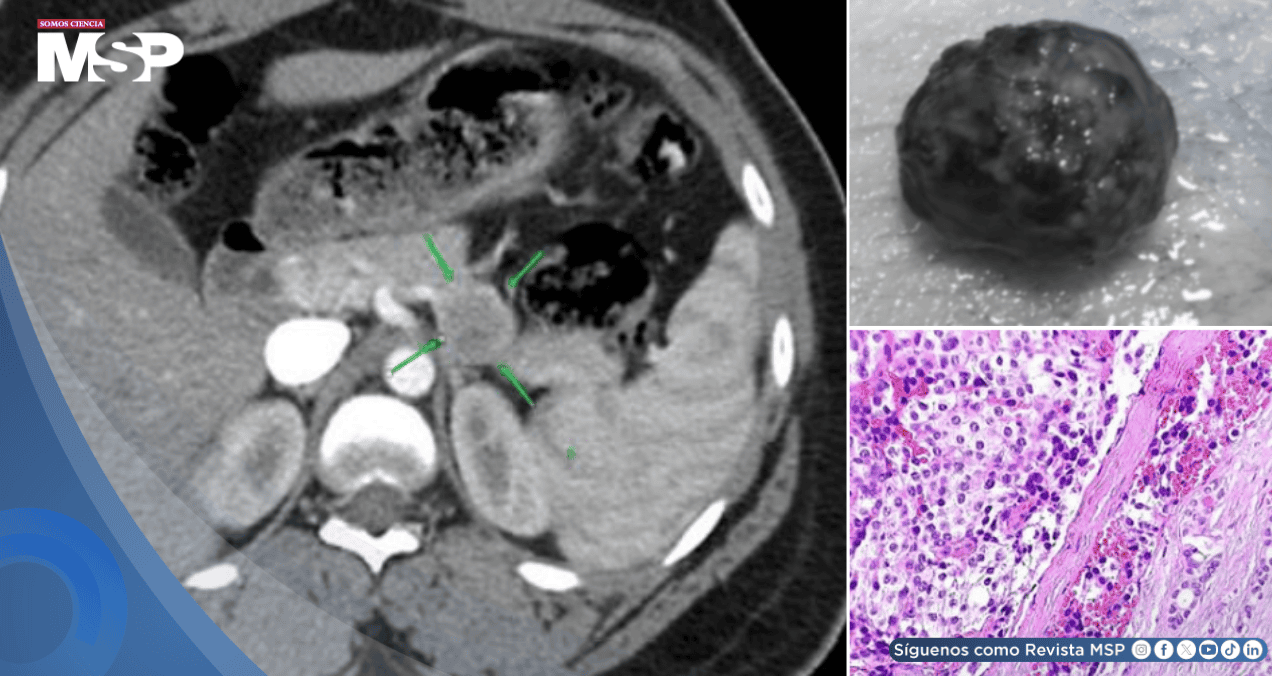 Tras 3 años tratada por epilepsia y esquizofrenia descubren tumor pancreático que ocasionaba los síntomas Tras 3 años tratada por epilepsia y esquizofrenia descubren tumor pancreático que ocasionaba los síntomas
