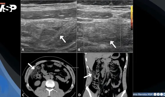 Dolor abdominal severo en paciente de 32 años resultó ser un infarto omental y no apendicitis