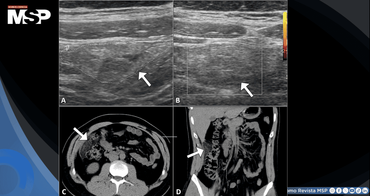 Dolor abdominal severo en paciente de 32 años resultó ser un infarto omental y no apendicitis Dolor abdominal severo en paciente de 32 años resultó ser un infarto omental y no apendicitis