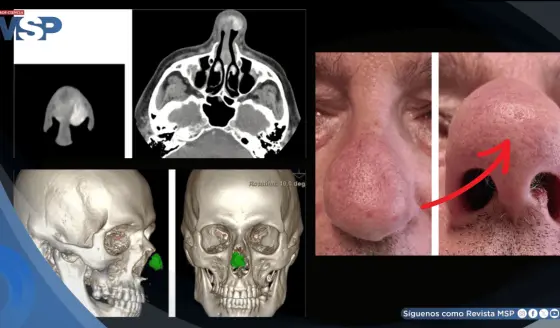 Detectan en hombre con gota crónica un bulto nasal causado por acumulación de cristales de ácido úrico